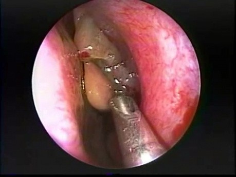 Nasal Polypectomy - Endoscopy 