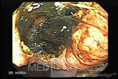 Gastric Cancer - Source of Bleeding