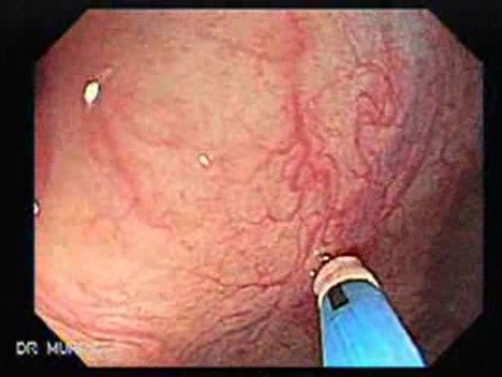 Colon Angiodysplasia (3 of 24)