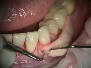 Preprosthetic Soft Tissue Reconstruction