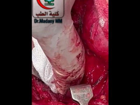 Non Recurrent Laryngeal Nerve Another Case