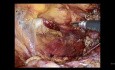 Four Times Recurrence Inguinal Hernia. Succesful Laparoscopic Repair.
