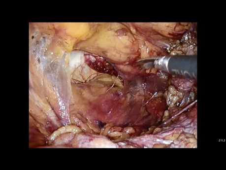 Four Times Recurrence Inguinal Hernia. Succesful Laparoscopic Repair.