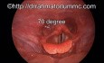 Hypopharyngeal and laryngeal inlet