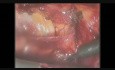 Laparoscopic Umbilical Hernia Repair