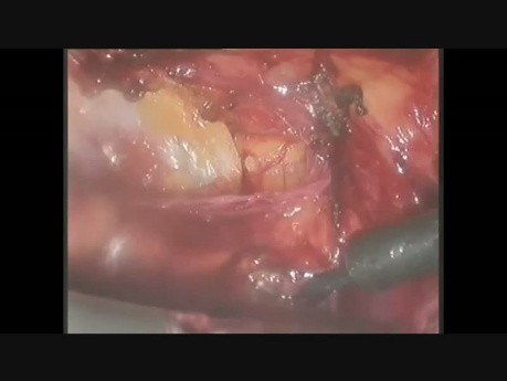 Laparoscopic Umbilical Hernia Repair
