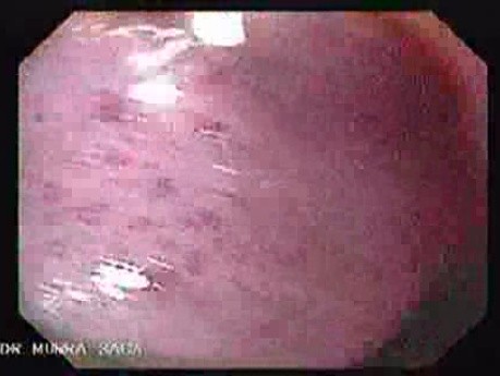 Endoscopic Variceal Ligation - Closer Look at the Varix (Magnifying View), Part 1