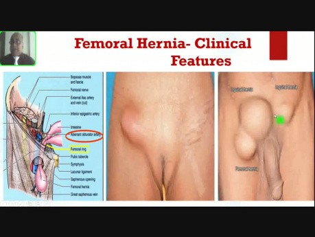 Femoral Hernia - Groin Swellings
