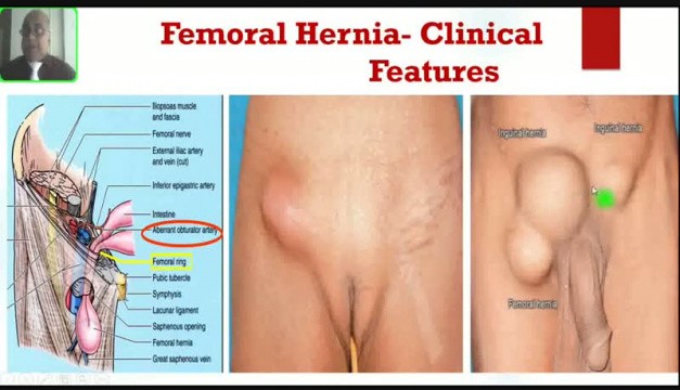 Femoral Hernia - Groin Swellings • Video •