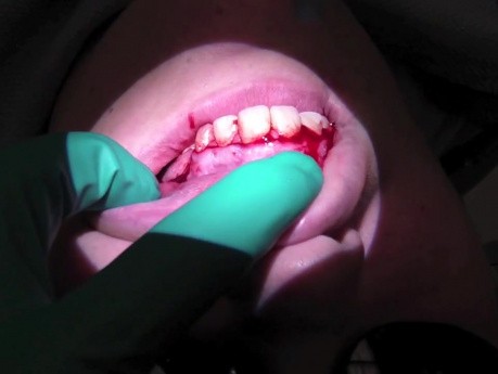 Apicoectomy Flap Elevation