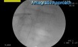 Antegrade Ureterolithotripsy