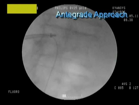 Antegrade Ureterolithotripsy