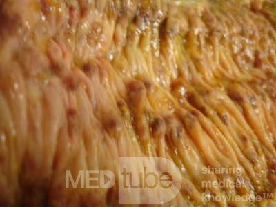 Toxic Dilatation of the Colon Superimposed pseudomembranous colitis involving the
 right colon (13 of 17)