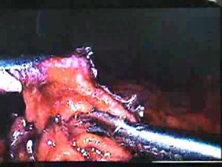 Jejunal Gastrointestinal Stromal tumor (GIST) (58 of 86)