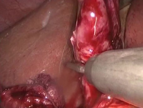 Acute cholecystitis