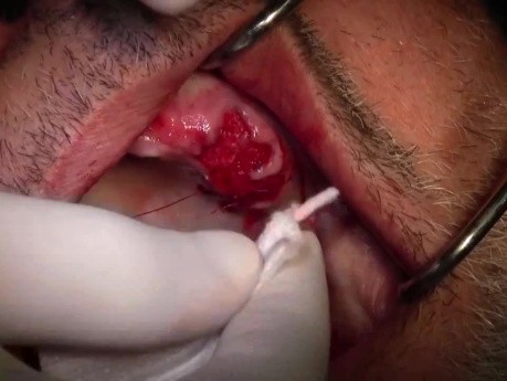 Extractions #11-13 With Simple Socket Bone Grafting, Part Ii