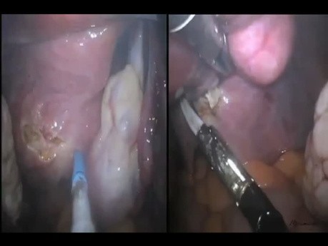 LESS Cholescystectomy with Concomitant Total Hysterectomy and Bilateral Salpingo-Oophorectomy
