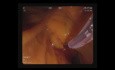 Duodenotomy & Biliary SEMS-ERCP