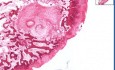 Osteoarthritis - Subchondral Cyst