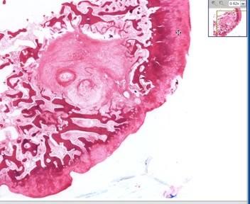 Osteoarthritis - Subchondral Cyst