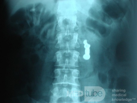 Dental Prothesis Found in the Jejuno (8 of 9)
