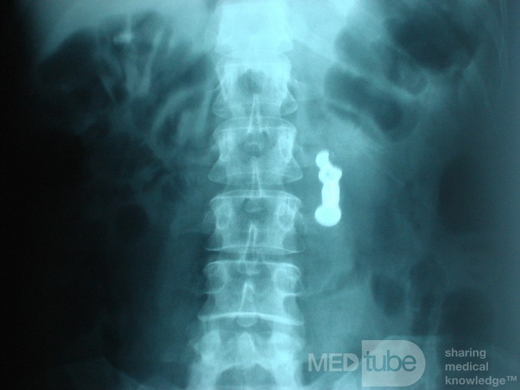 Dental Prothesis Found in the Jejuno (8 of 9)