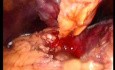 Gastrointestinal Stromal Tumor - GIST (46 of 65)