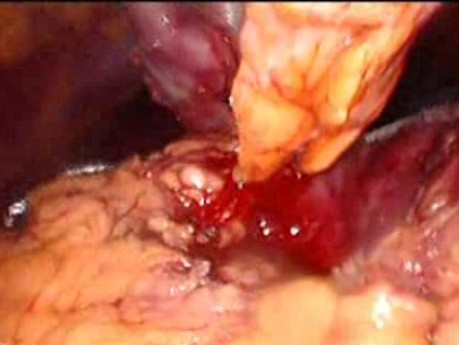 Gastrointestinal Stromal Tumor - GIST (46 of 65)