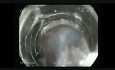 Minimally Invasive Endoscopic Techniques in Treatment of Gastric Neuroendocrine Tumors