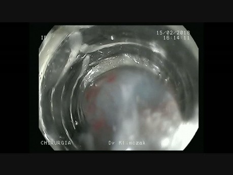 Minimally Invasive Endoscopic Techniques in Treatment of Gastric Neuroendocrine Tumors