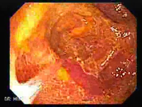 Ascending Colon Cancer (1 of 6)