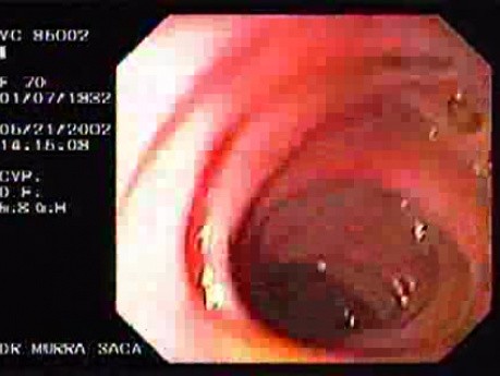Erythematous Colon Mucosa (1 of 3)