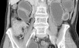 Right Colon Tumor with Intestinal Obstruction