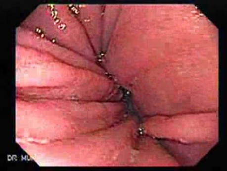 Hourglass Stomach - Closer Look at the Generative Epithelium, Part 2
