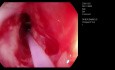 CRE Esophageal Balloon Dilatation - Second Session