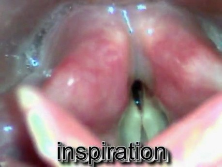 Bilateral and unilateral vocal fold paralysis