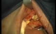 Rebuild Of Madnibular Implant Site (3/4)