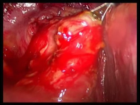 Transcholedochoscopic Basketing of CBD Stones