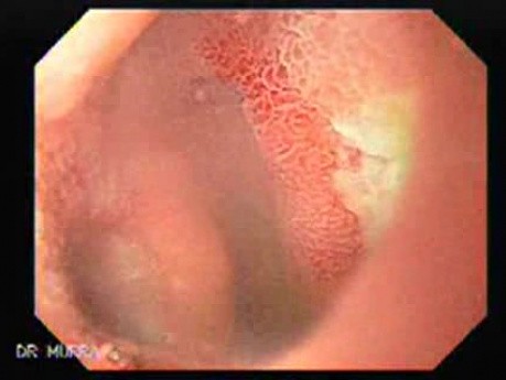 Kissing Duodenal Ulcer