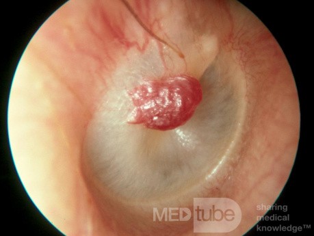 Capillary Hemangioma of the Tympanic Membrane