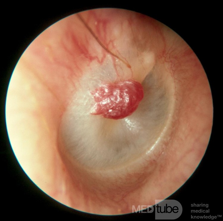 Capillary Hemangioma of the Tympanic Membrane