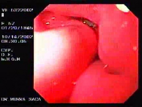 Gastric Ulcer at the Antrum - 57 Years-Old Woman