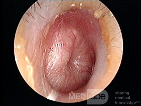 Acute Suppurative Otitis Media