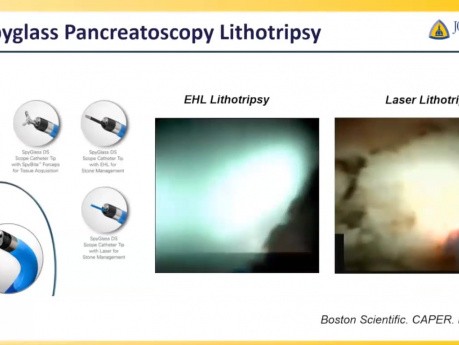 Medical and Endoscopic Management of Chronic Pancreatis