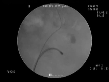 Calyceal Stone - Retrograde Contrast Infusion