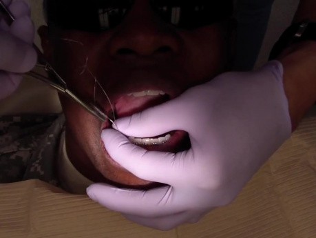 Orthodontic Case #3 Mesialize Maxillary Posterior Segment - Fabricate A Kobayashi Wire/Hook