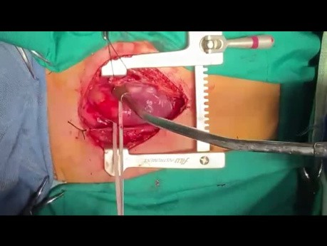 Pulmonary Artery Banding, Indications and How To Do It? 