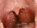 Acute Follicular Tonsillitis