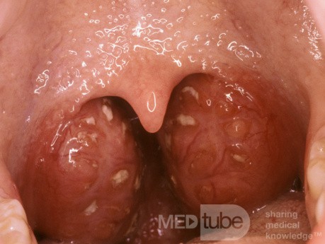 Acute Follicular Tonsillitis