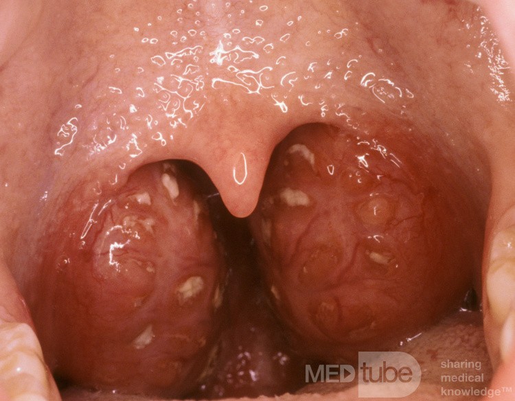 Acute Follicular Tonsillitis